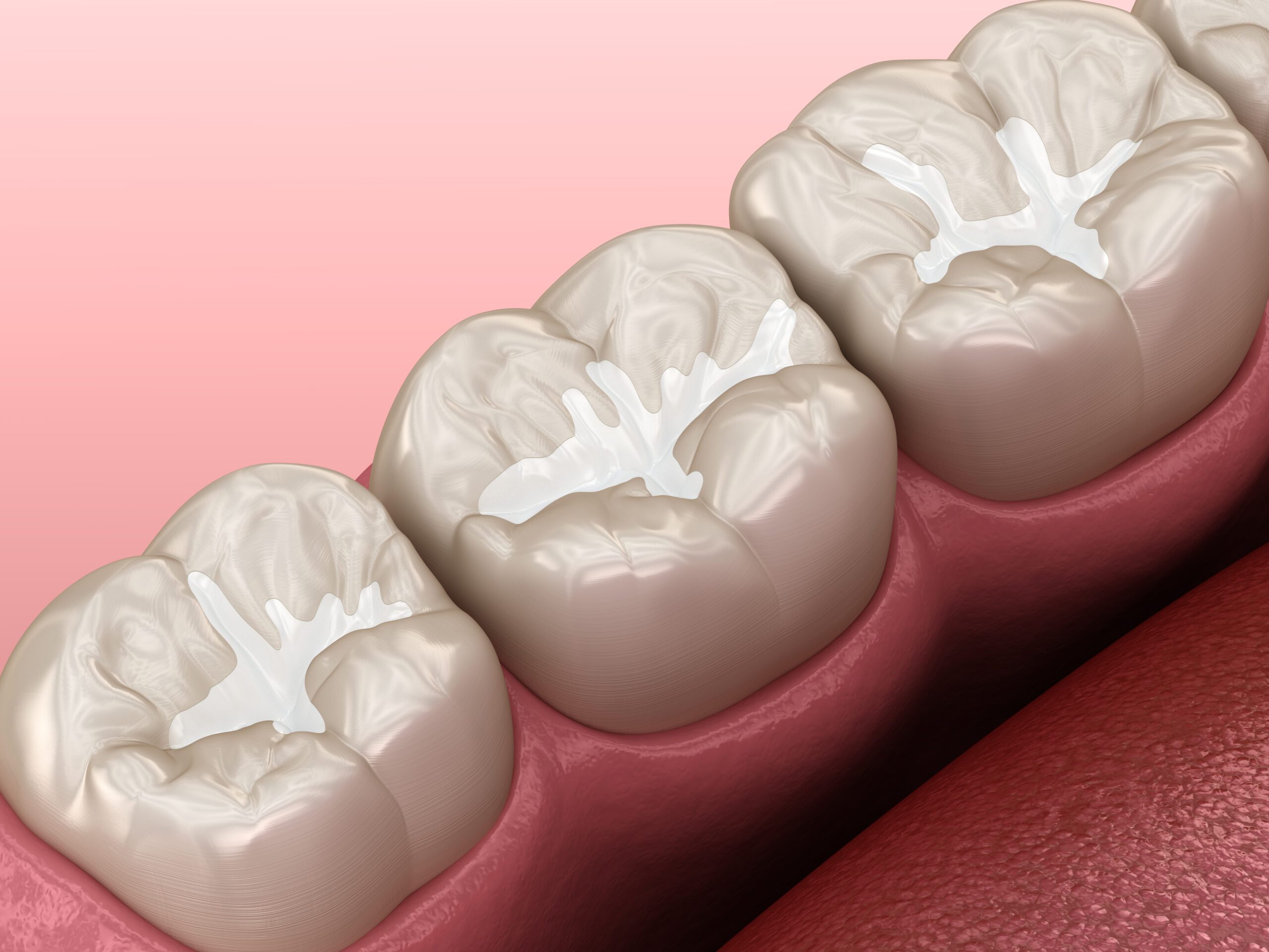 sealants family dentist Salt Lake City