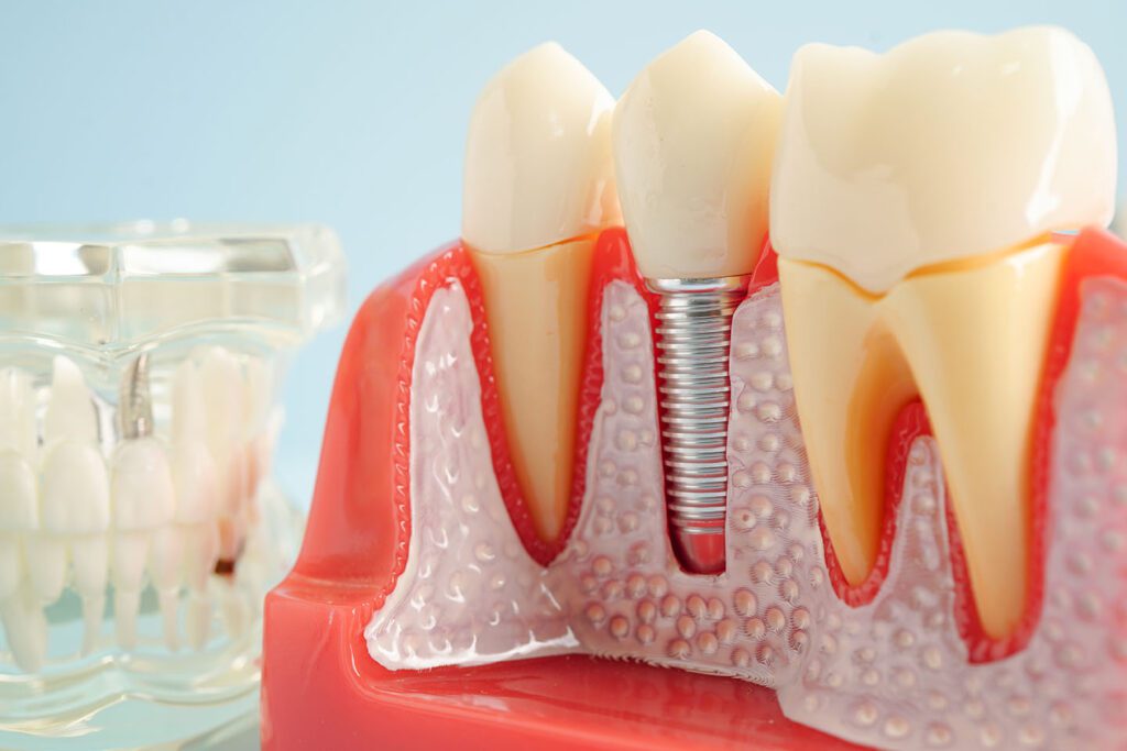 implant restoration dental implant Salt Lake City