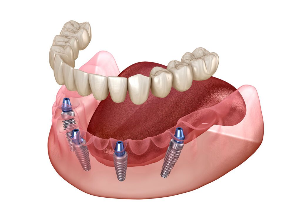 dental implants Salt Lake City All-on-Four Hybrid Prosthesis