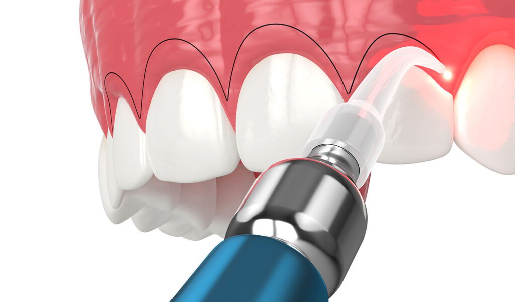 Gingivectomy dentist Salt Lake City